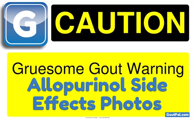 Warning: Photos of Allopurinol Side Effects